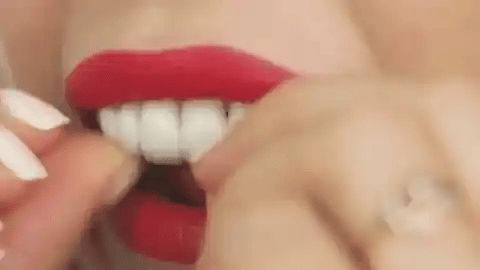 Protesis Dental Snap On Smile