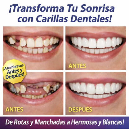 Protesis Dental Snap On Smile
